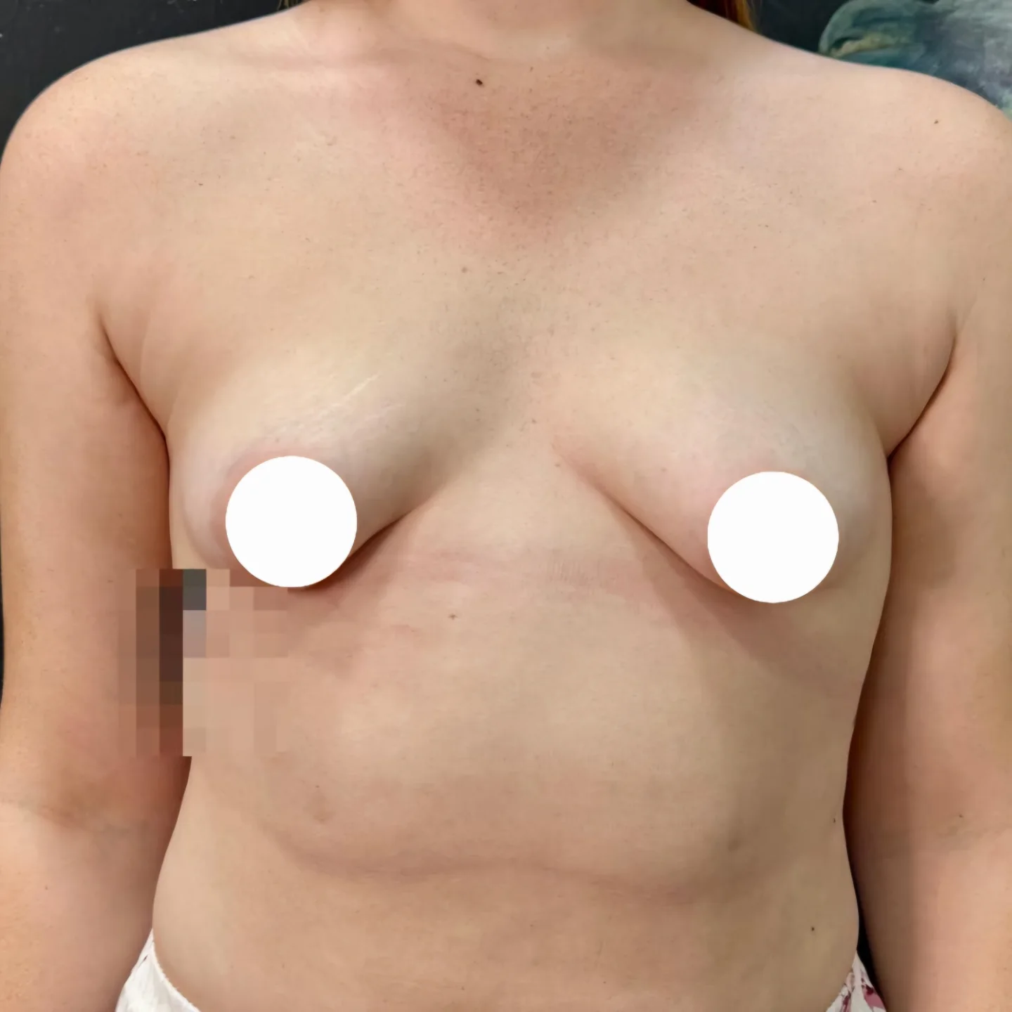Breast Augmentation and Symmetry Before
